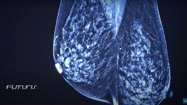 Nanocargo: Η νέα μέθοδος θεραπείας του καρκίνου του μαστού με νανοσωματίδια
