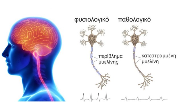 Παγκόσμια Ημέρα για την Σκλήρυνση κατά Πλάκας